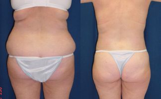 Before and after photo of an actual Body Lift patient.