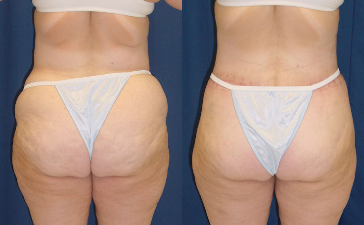 Before and after photo of an actual Body Lift patient.