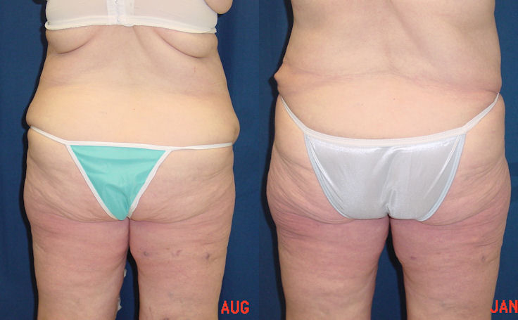 Before and after photo of an actual Body Lift patient.