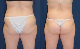 Before and after photo of an actual Body Lift patient.