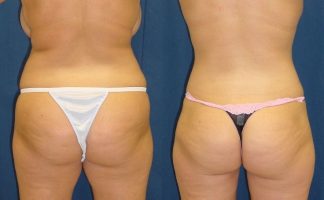 Before and after photo of an actual Body Lift patient.