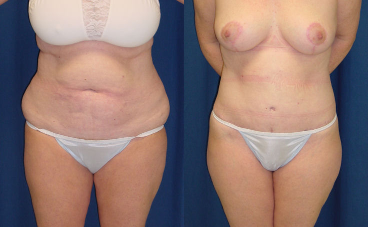 Before and after photo of an actual Body Lift patient.