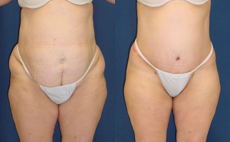 Before and after photo of an actual Body Lift patient.