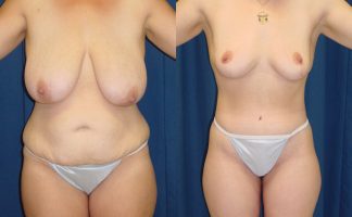 Before and after photo of an actual Body Lift patient.