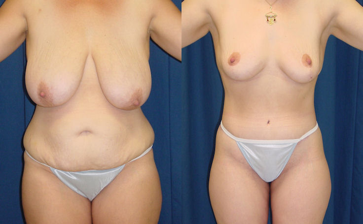 Before and after photo of an actual Body Lift patient.