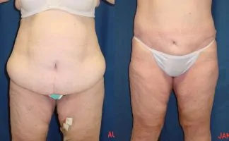 A collage of photos of a patient that had a Body lift after 100-lb weight loss