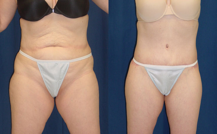 Before and after photo of an actual Body Lift patient.