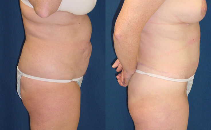 Before and after photo of an actual Body Lift patient.