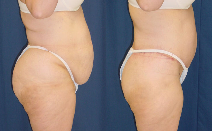 Before and after photo of an actual Body Lift patient.