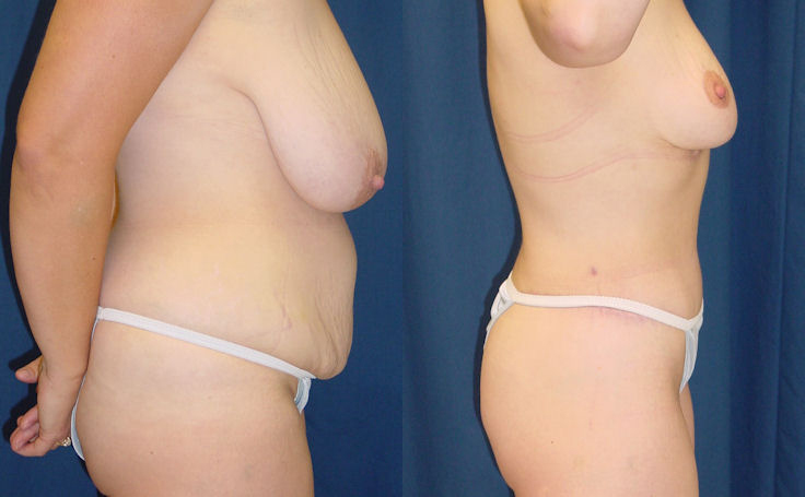 Before and after photo of an actual Body Lift patient.