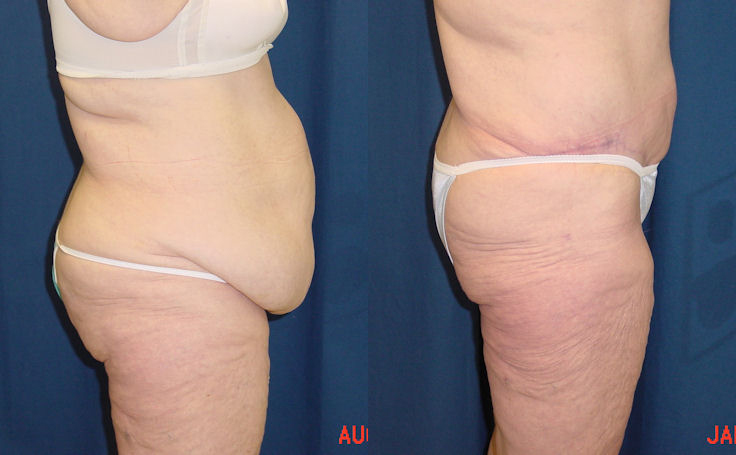 Before and after photo of an actual Body Lift patient.