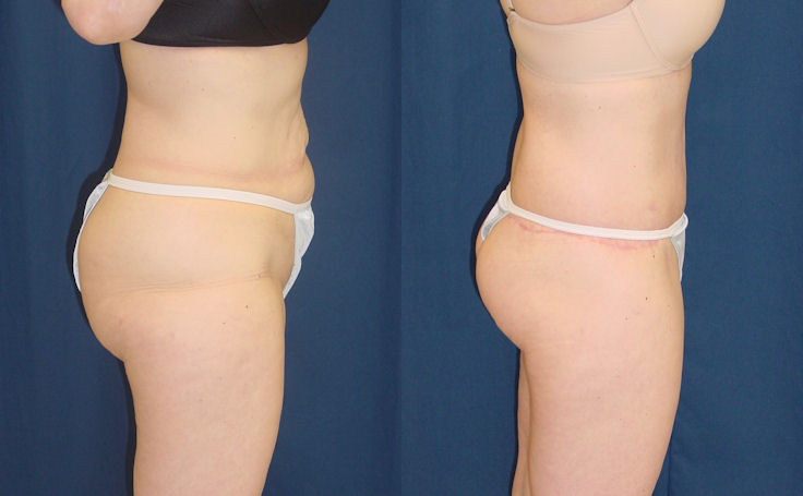 Before and after photo of an actual Body Lift patient.