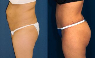 Before and after photo of an actual Body Lift patient.