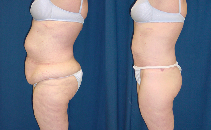 Before and after photo of an actual Body Lift patient.