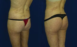 Before and after photo of an actual Brazilian Butt Lift patient.