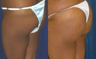 Before and after photo of an actual Brazilian Butt Lift patient.