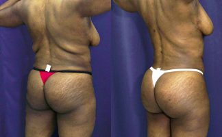 Before and after photo of an actual Brazilian Butt Lift patient.