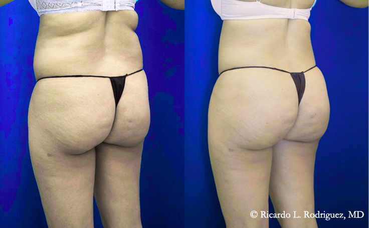 Before and after photo of an actual Brazilian Butt Lift patient.