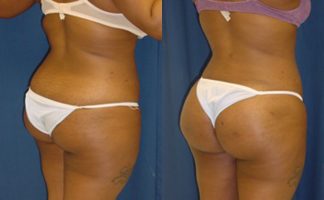 Before and after photo of an actual Brazilian Butt Lift patient.