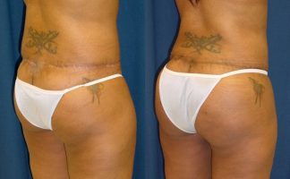 Before and after photo of an actual Brazilian Butt Lift patient.