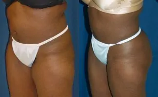 Before and after photo of an actual Brazilian Butt Lift patient.