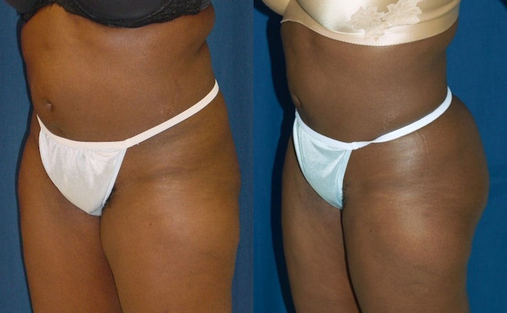 Before and after photo of an actual Brazilian Butt Lift patient.