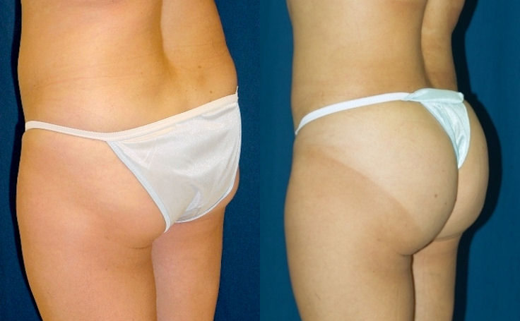 Before and after photo of an actual Brazilian Butt Lift patient.