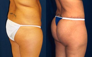 Before and after photo of an actual Brazilian Butt Lift patient.