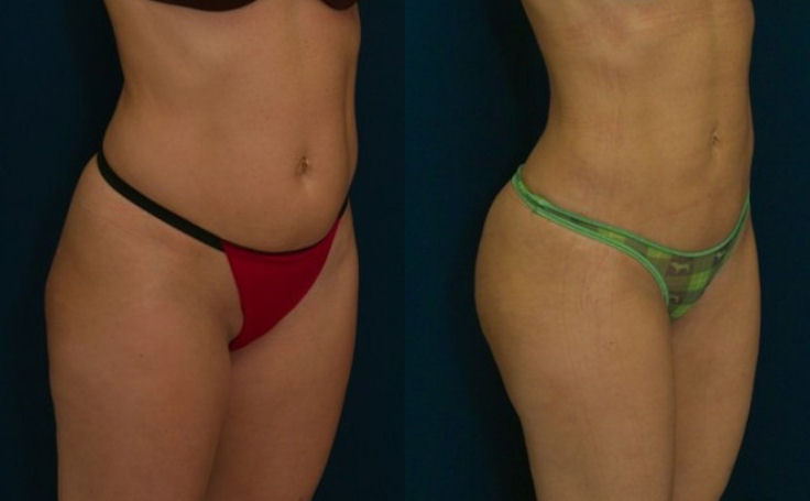 Before and after photo of an actual Brazilian Butt Lift patient.