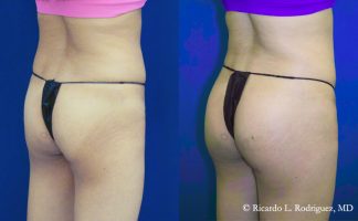 Before and after photo of an actual Brazilian Butt Lift patient.