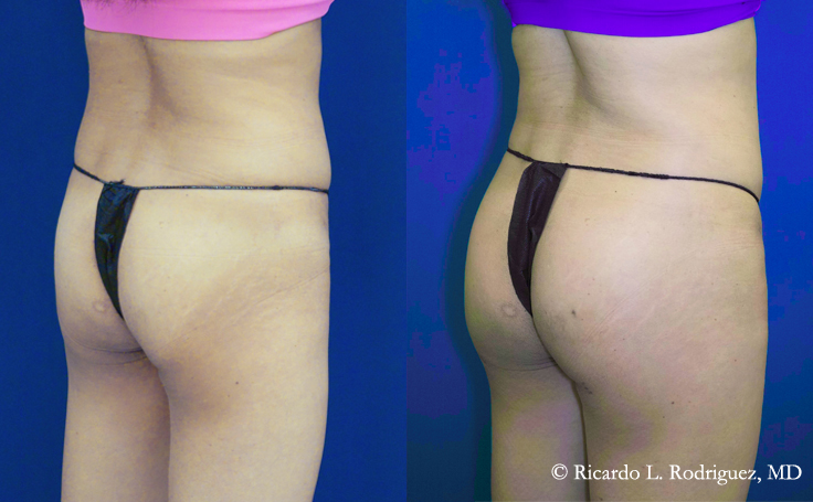 Brazilian Butt Lift (BBL) Before & After Photos Patient 109