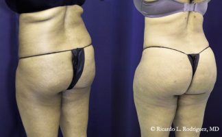 Before and after photo of an actual Brazilian Butt Lift patient.