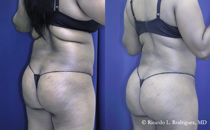 Before and after photo of an actual Brazilian Butt Lift patient.