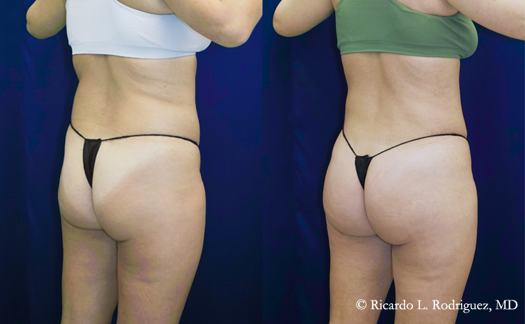 Before and after photo of an actual Brazilian Butt Lift patient.