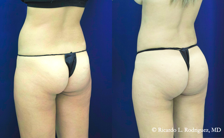 Before and after photo of an actual Brazilian Butt Lift patient.