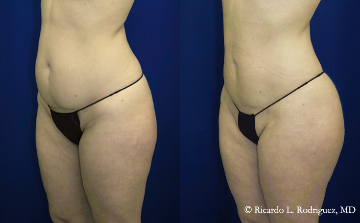 frontal before and after pictures of a brazilian butt lift patient