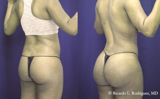 Before & After Lipo of flanks - Dr. Rodriguez, Cosmeticsurg