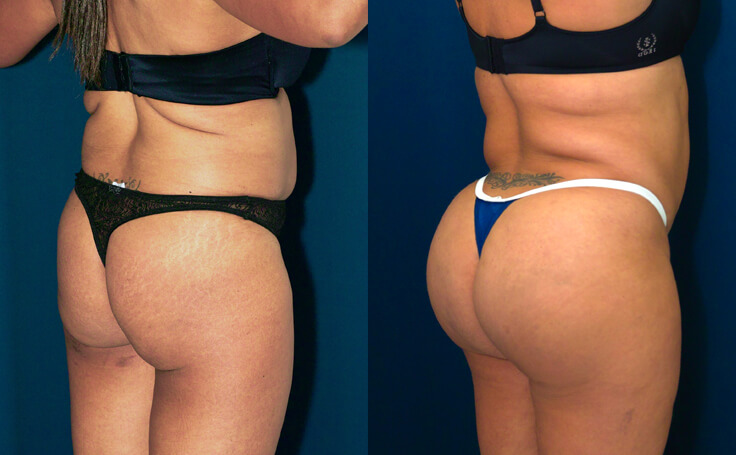 Fat Grafting to Buttock (Brazilian Butt Lift) Results: Before and