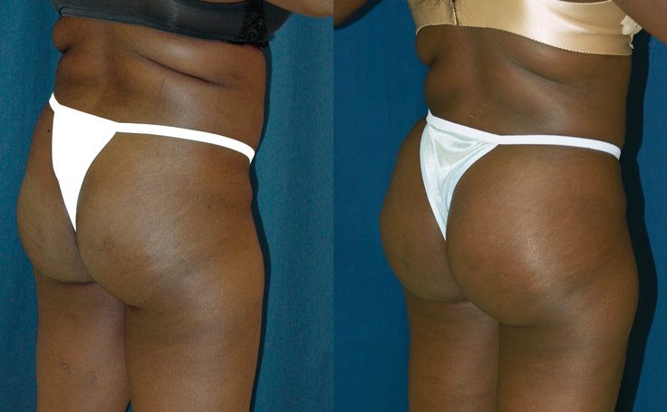 Before and after photo of an actual Brazilian Butt Lift patient.