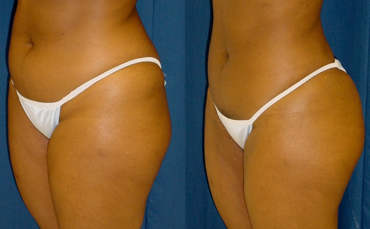 Before and after photo of an actual Brazilian Butt Lift patient.