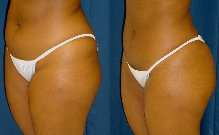 Before and after photo of an actual Brazilian Butt Lift patient.