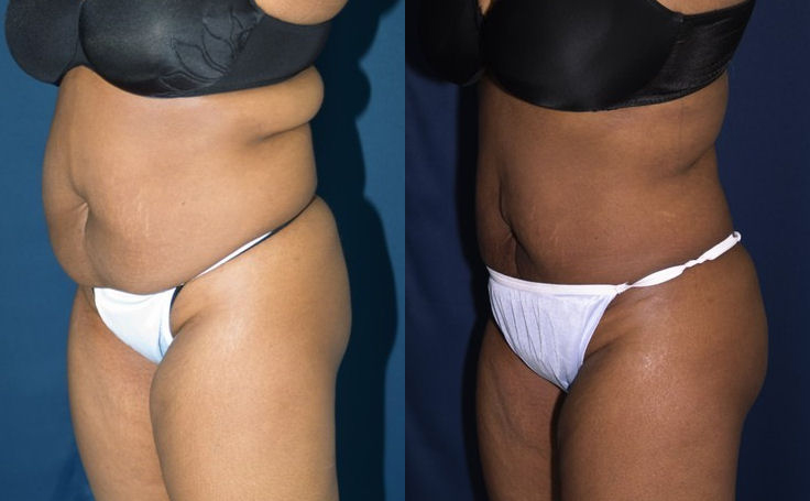 Before and after photo of an actual Brazilian Butt Lift patient.