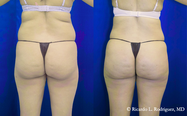 Before and after photo of an actual Brazilian Butt Lift patient.