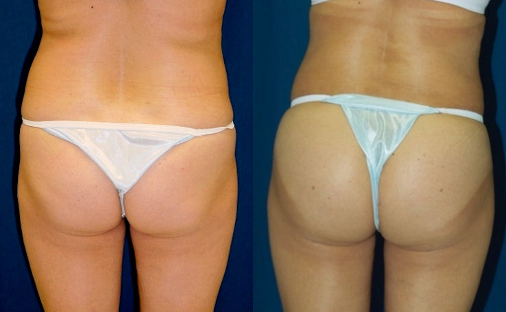 Before and after photo of an actual Brazilian Butt Lift patient.