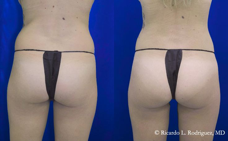 Before and after photo of an actual Brazilian Butt Lift patient.