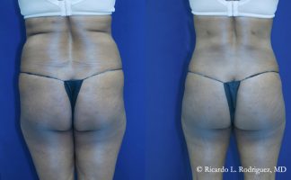 Before and after photo of an actual Brazilian Butt Lift patient.