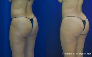 photo of a patient before and after a brazilian butt lift
