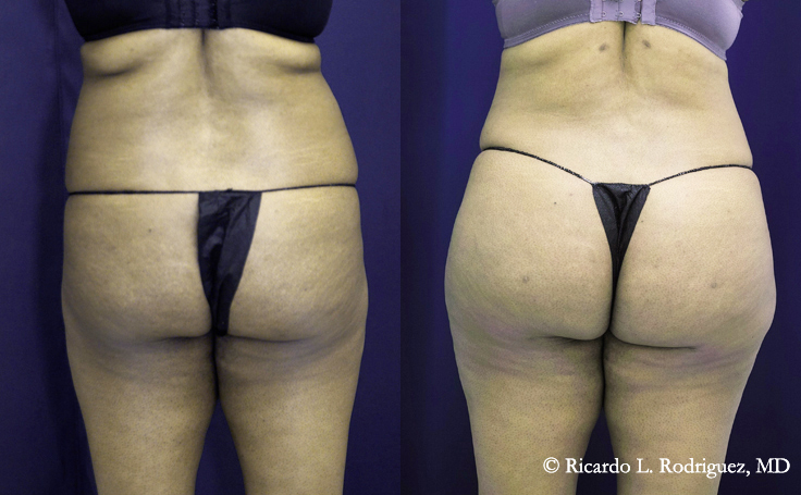 Before and after photo of an actual Brazilian Butt Lift patient.