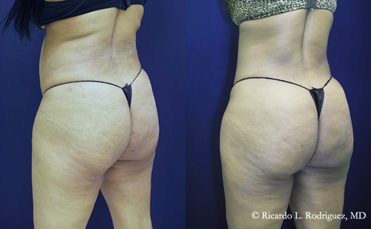 Before and after photo of an actual Brazilian Butt Lift patient.