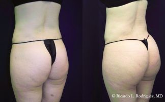 pictures of a patient before and after brazilian butt lift